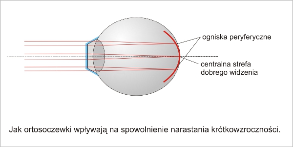 Jak ortosoczewki wpływają na spowolnienie narastania krótkowzroczności.