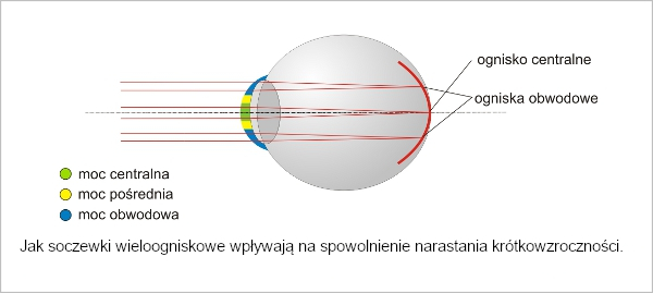 jak_soczewki_dwuogniskowe_wplywaja_na_spowolnienie_krotkowzrocznosci