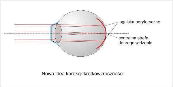 nowa_idea_korekcji_krotkowzrocznosci