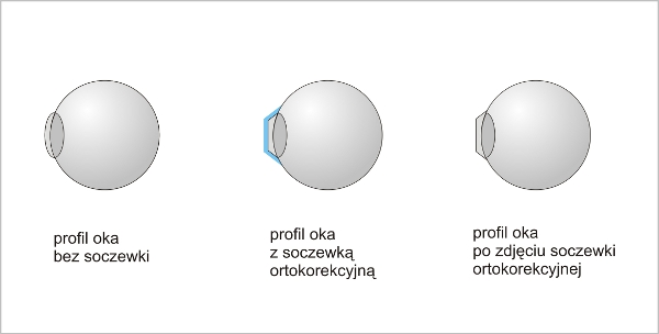 Korekcja krótkowzroczności ortosoczewką.