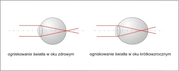 shemat_krotkowzrocznosc